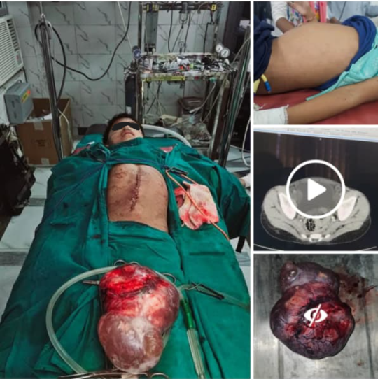Successful Resection of Large Abdominal Tumor